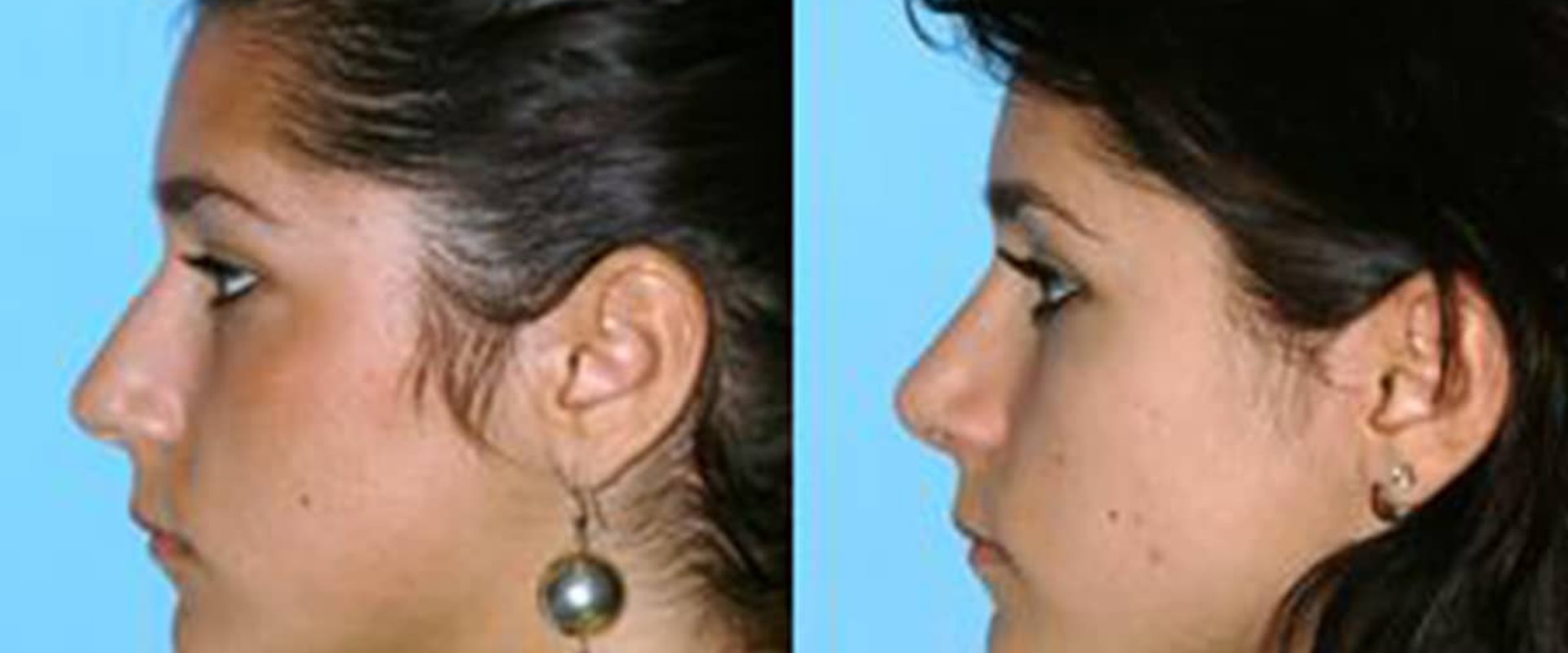 Prominent Rhinoplasty Surgeon in Beverly Hills CA