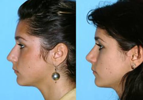 Prominent Rhinoplasty Surgeon in Beverly Hills CA